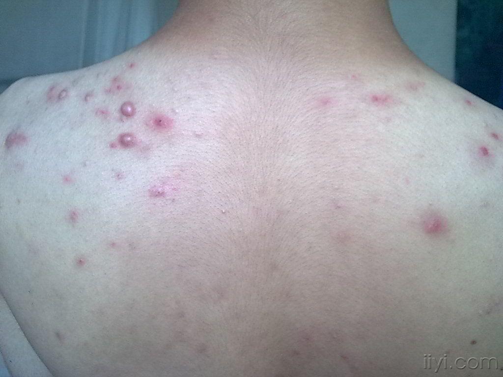 局封3次后 - 皮肤及性传播疾病讨论版 - 爱爱医医学论坛