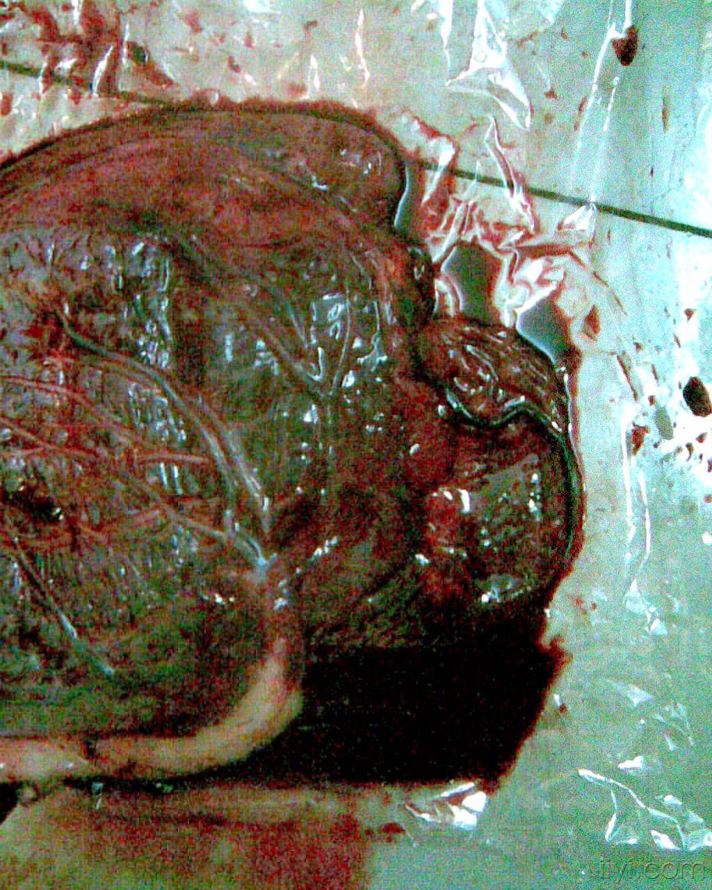 帆状胎盘前置血管图片图片