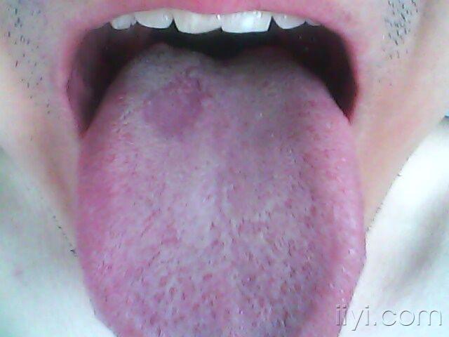 舌头紫斑图片图片