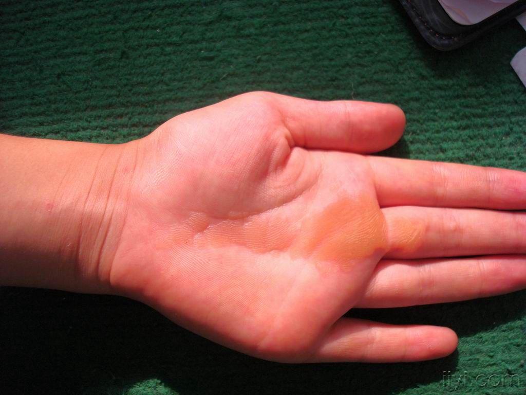 看图诊断6公布答案条状掌跖角化症