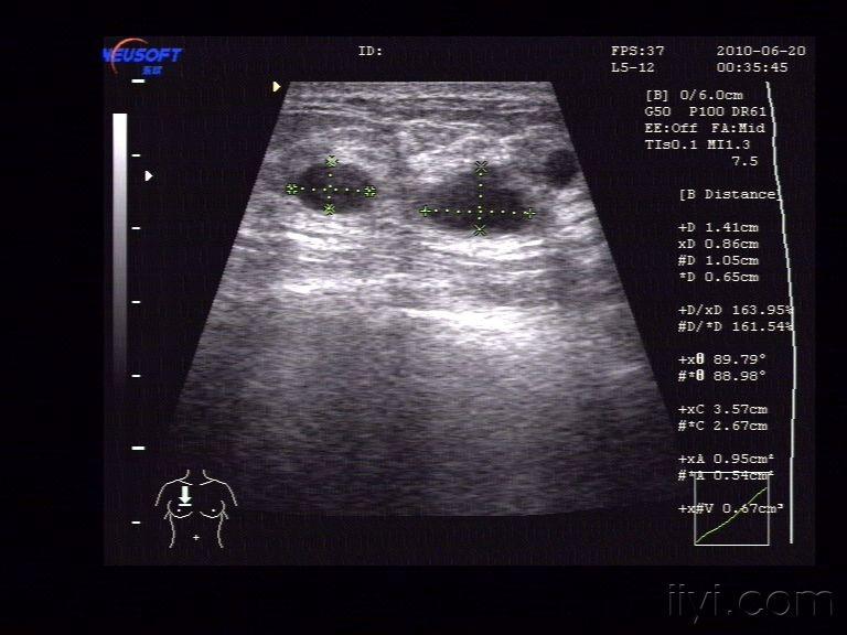 乳腺囊性增生 - 超声医学讨论版 - 爱爱医医学论坛