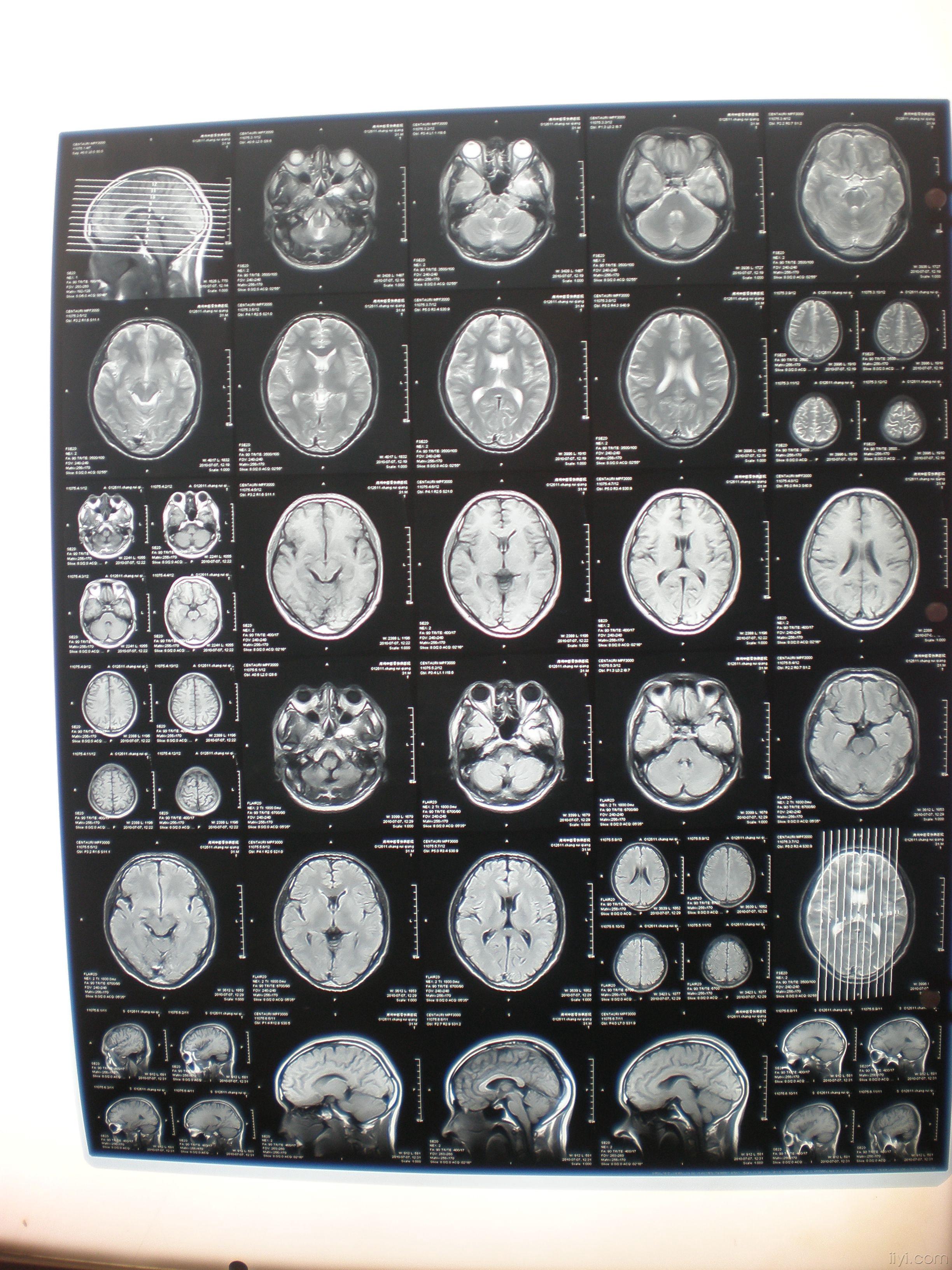 病例讨论一头颅mri扫描