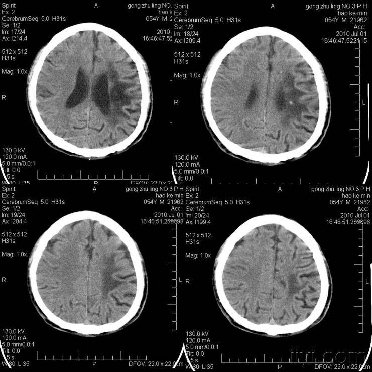 分享一例大面积脑梗塞的影像演变