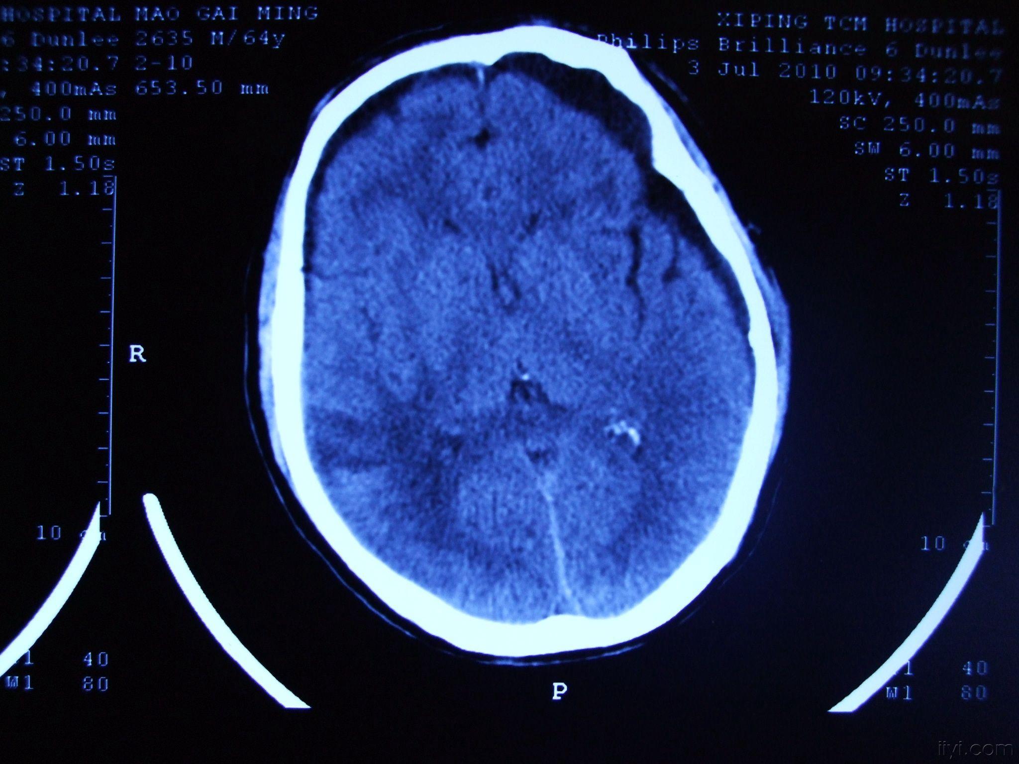 重型颅脑损伤治疗后出现硬膜下积液