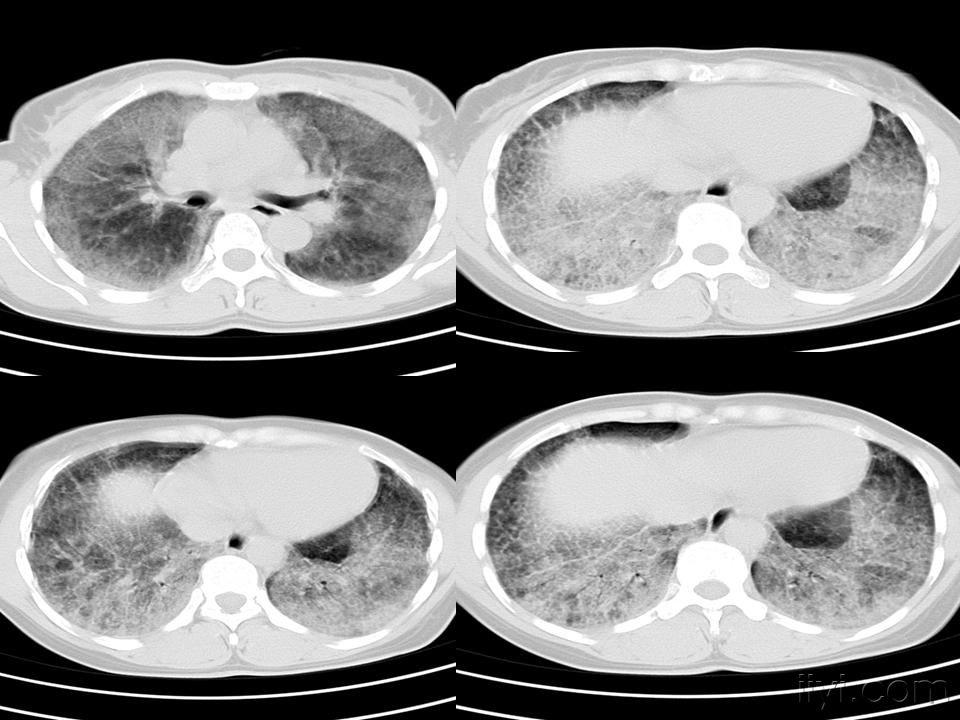 两肺弥漫毛玻璃变