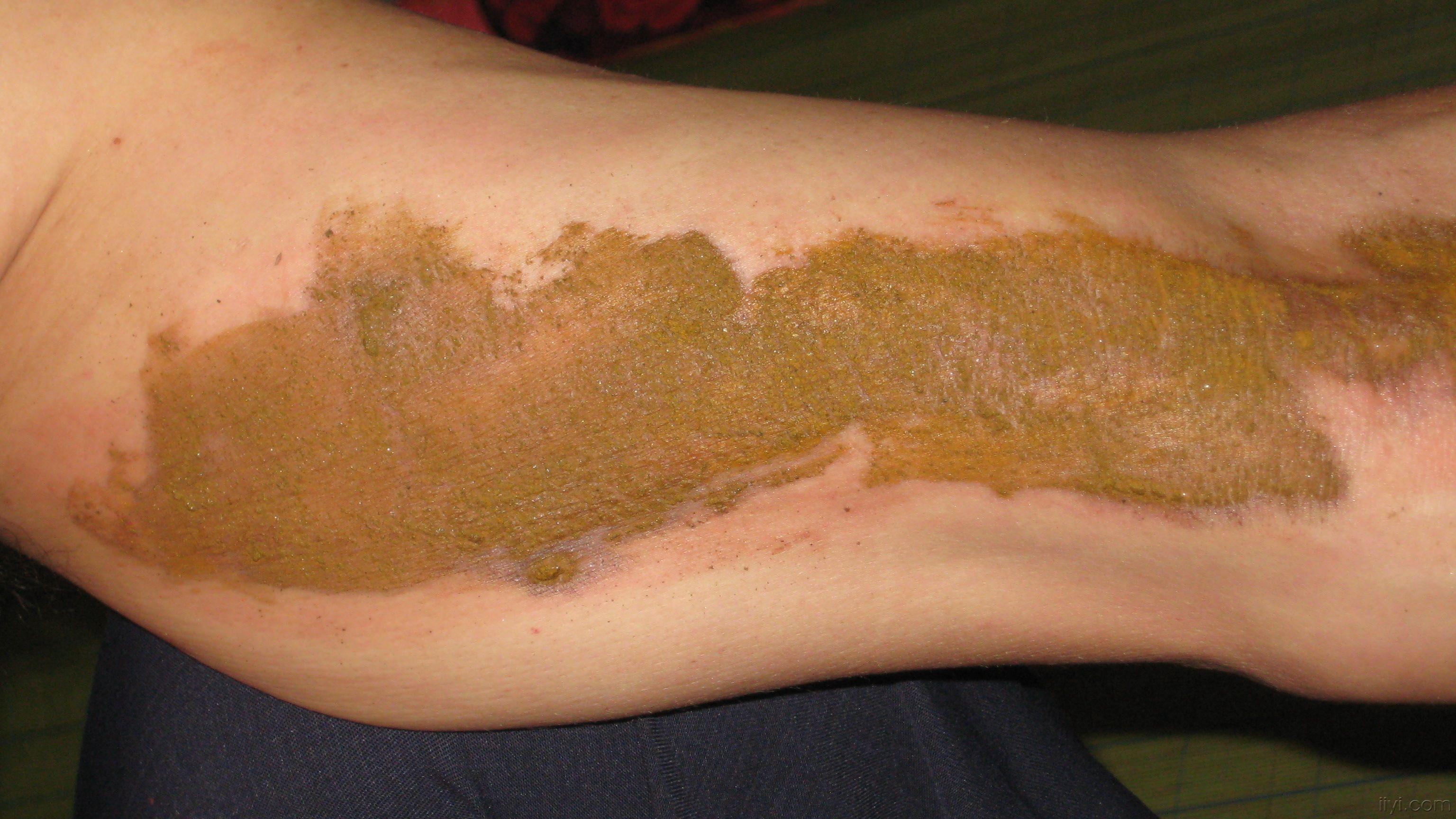 临床经验带状疱疹的治疗望同行指点