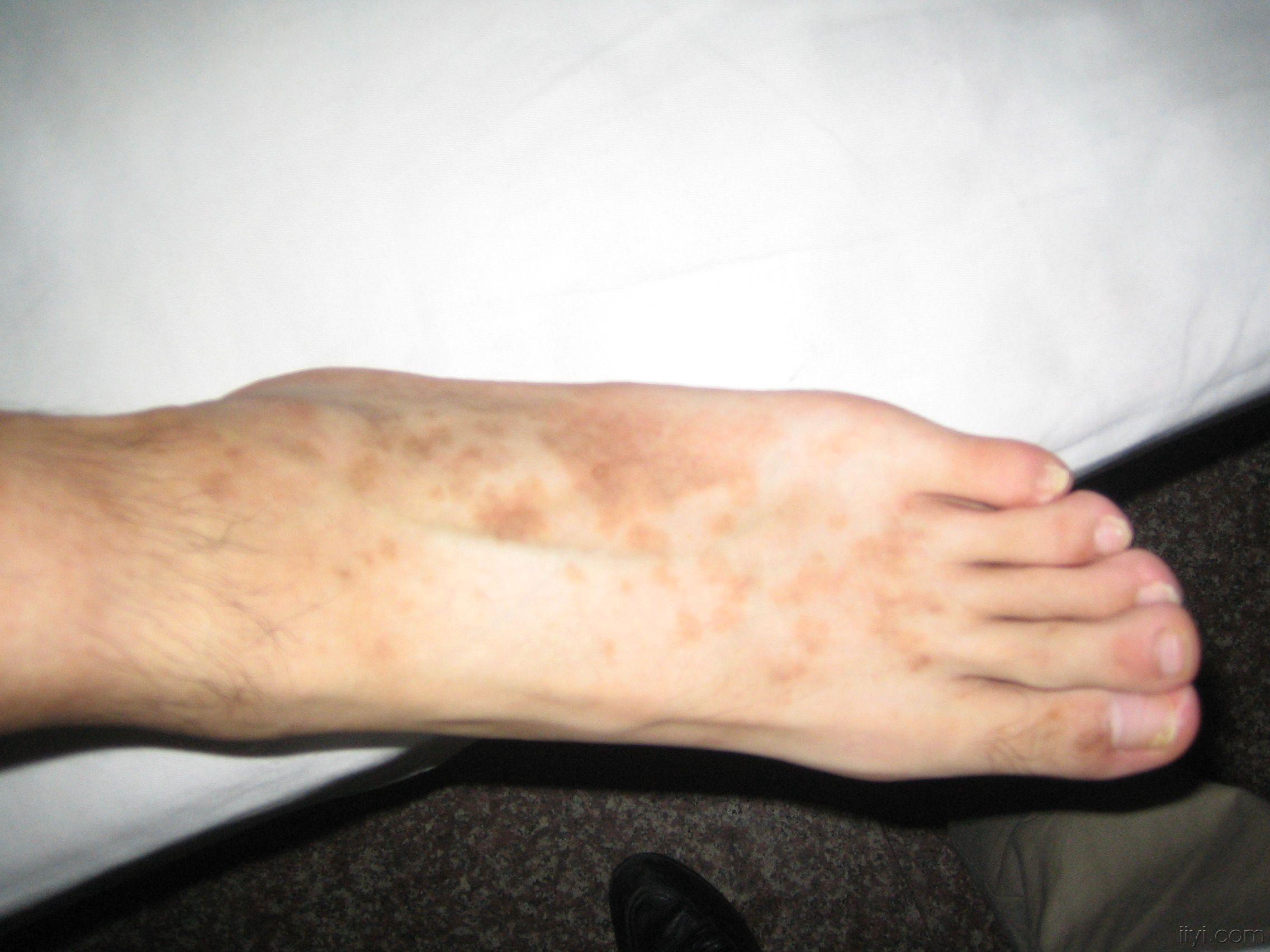 患者男,20岁,左脚背黑色素斑多年,请爱友们帮忙诊断治疗