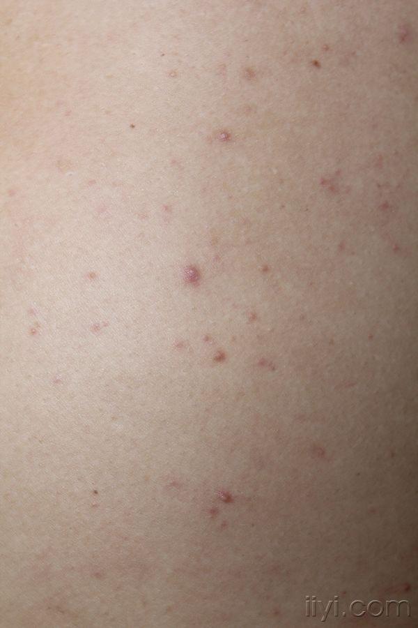 看图瘙痒性丘疹脓丘疹