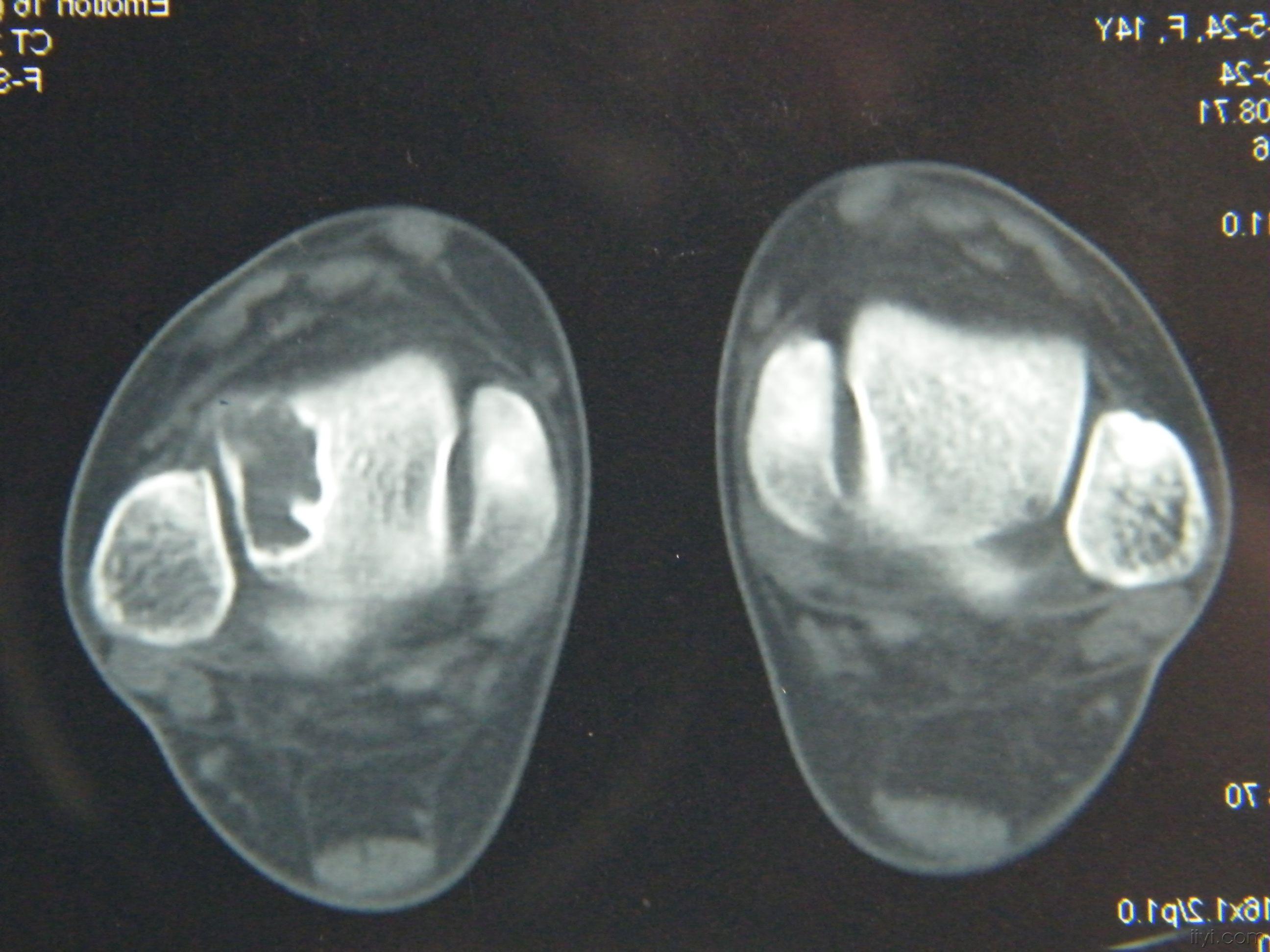 骨囊肿 早期图片