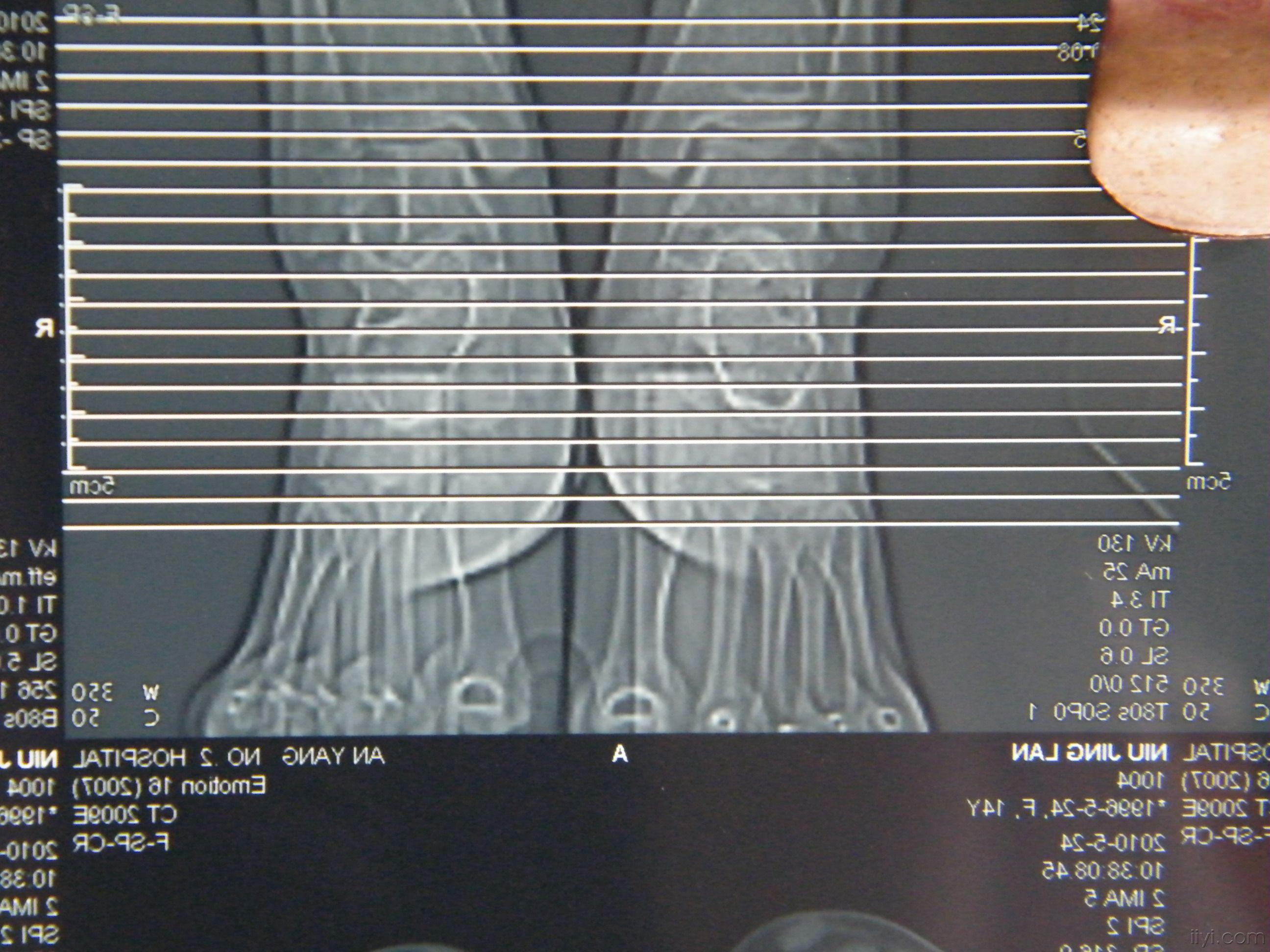 距骨骨髓水肿图片