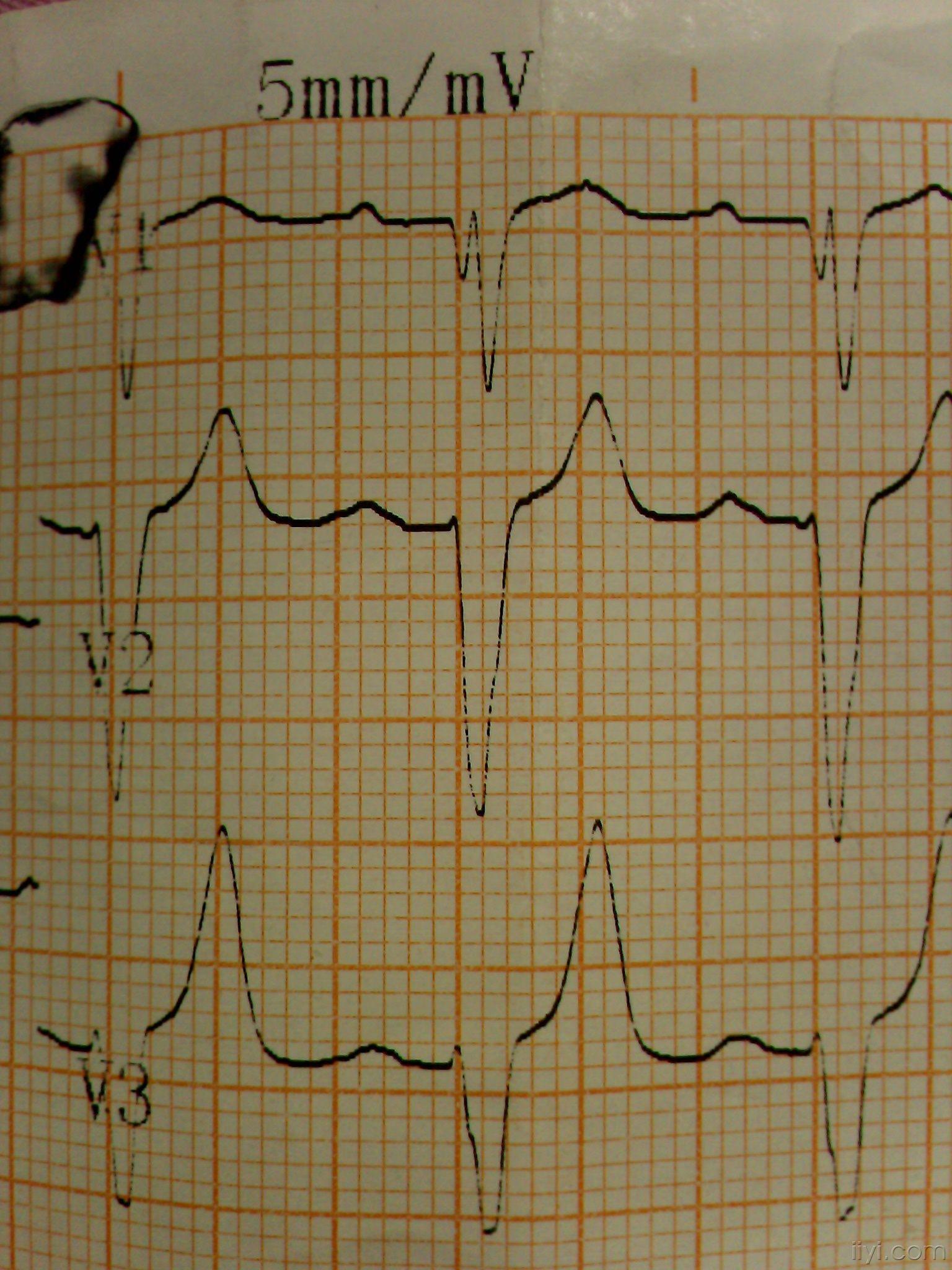 心电图v1呈m型图片