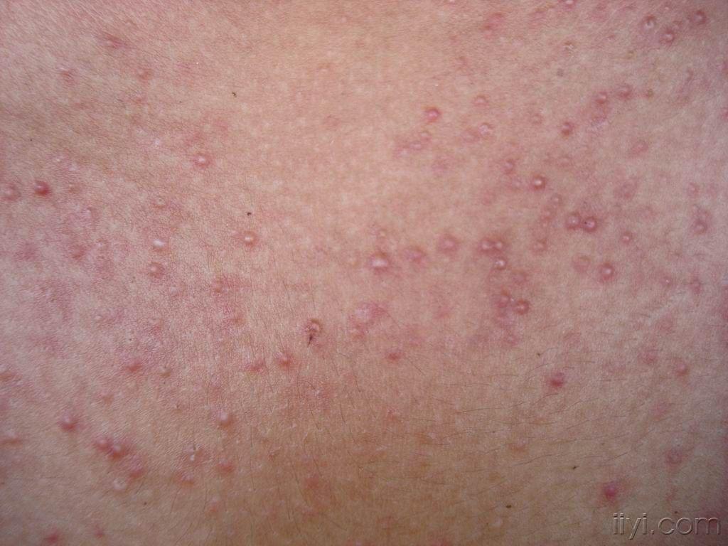 看图诊断8……公布答案:糠秕孢子菌毛囊炎 - 皮肤及性传播疾病讨论版