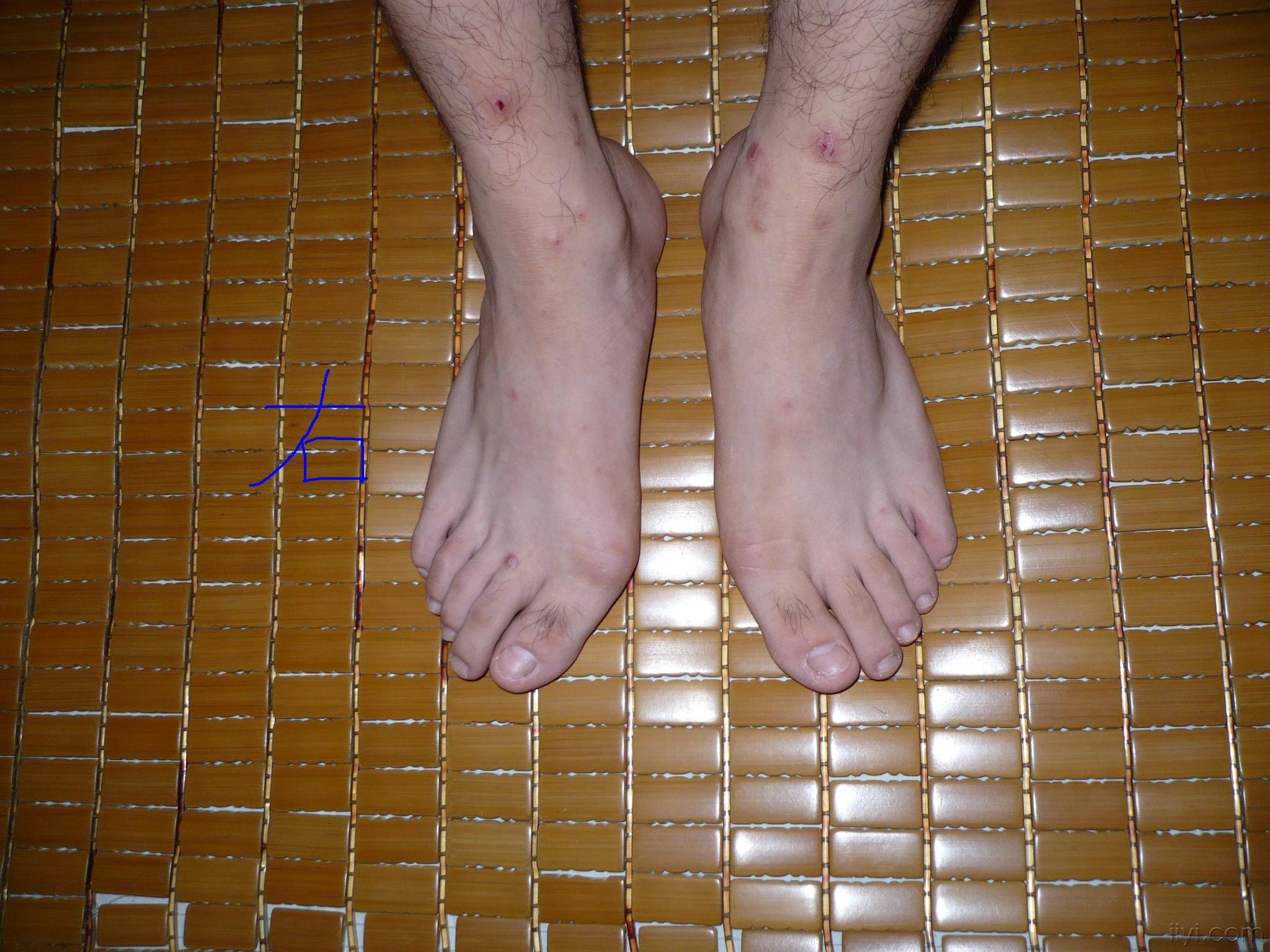 这个拇外翻怎么做