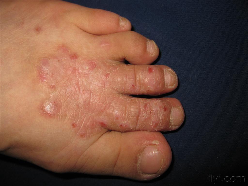 看图识病神经性皮炎