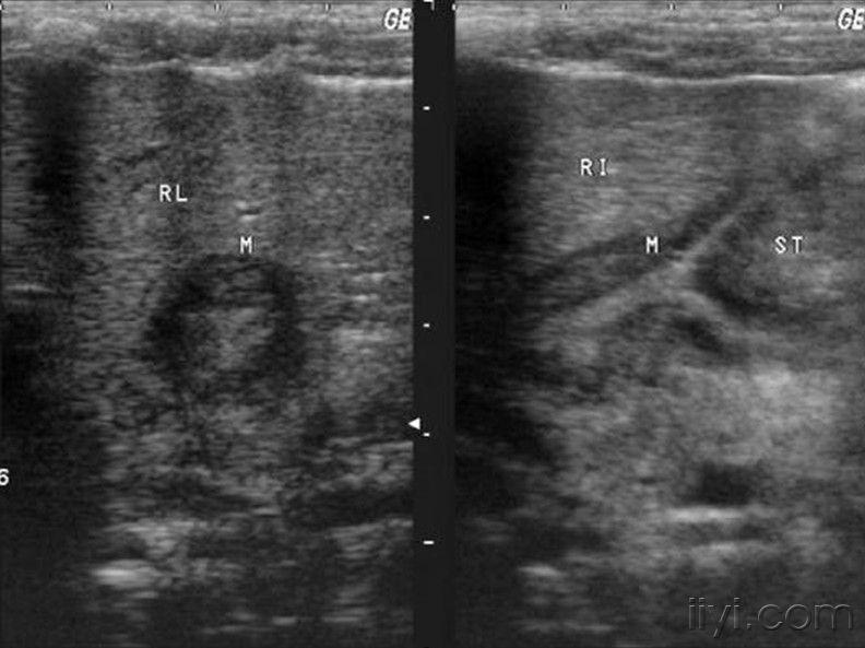 典型病例--幽门肥厚梗阻!