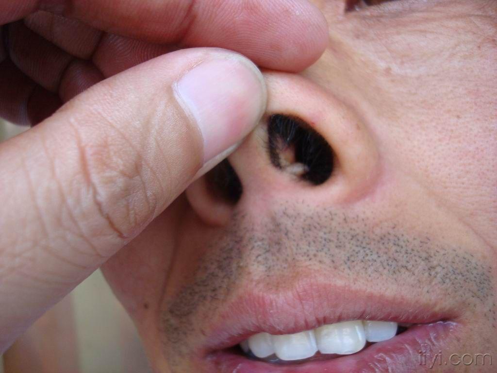 鼻前庭疣图片