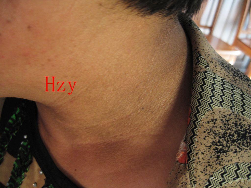 色素沉着怎么去除腋下 1007242213e7e86c3ed9963412.jpg