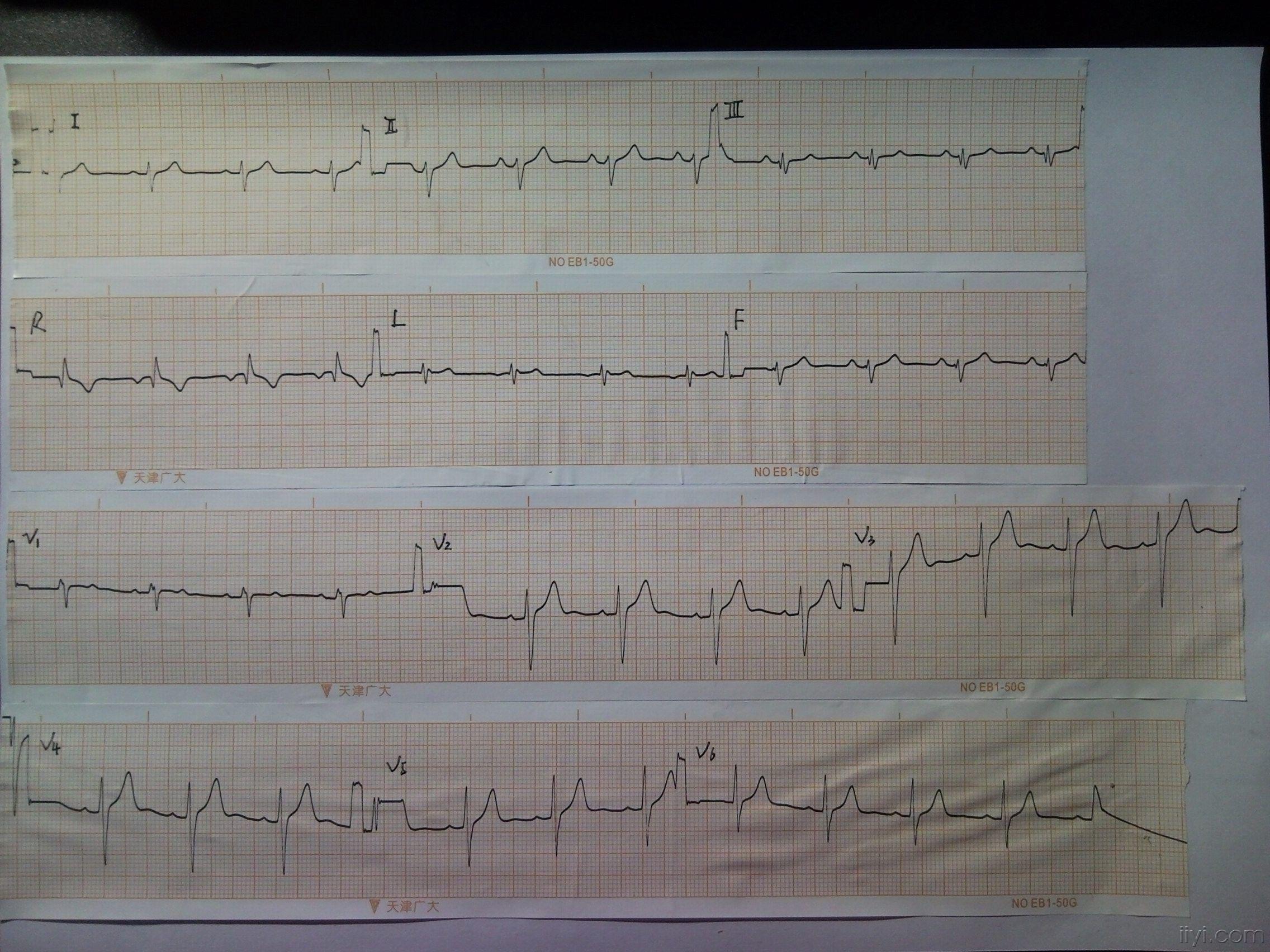 胸透心电图图片