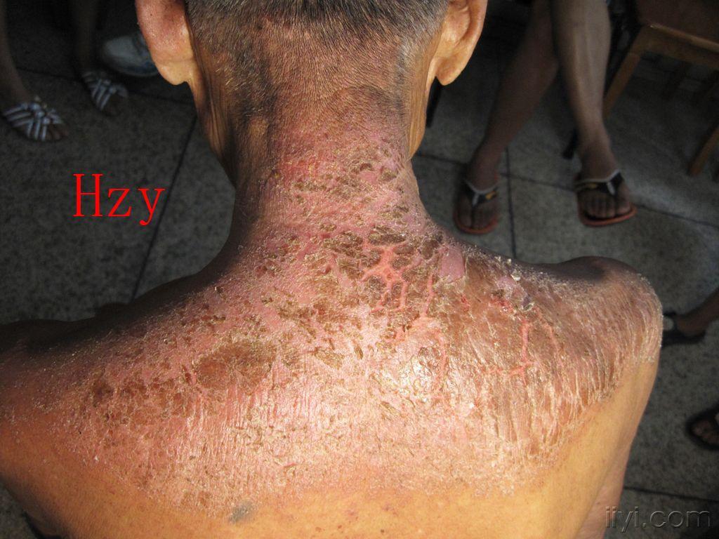 公布答案:接触性皮炎 - 皮肤及性传播疾病讨论版 - 爱爱医医学论坛