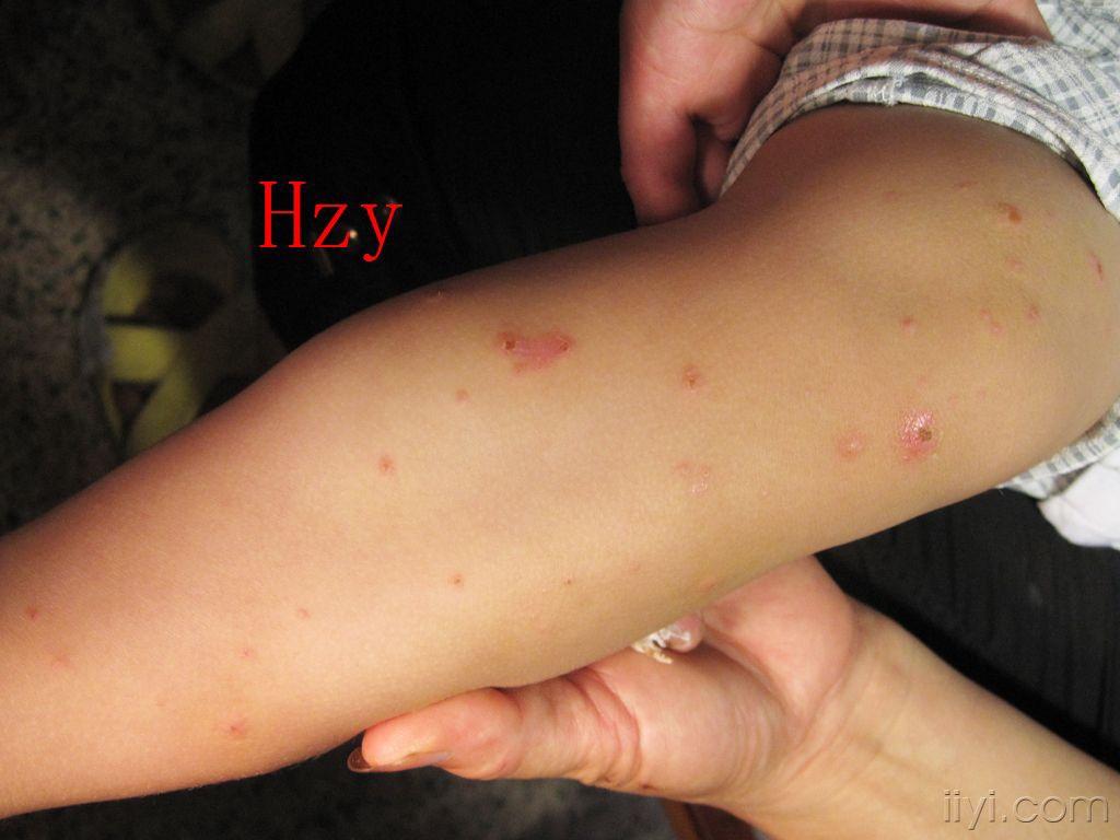 小儿四肢有多数散在皮损公布答案丘疹性肢端皮炎