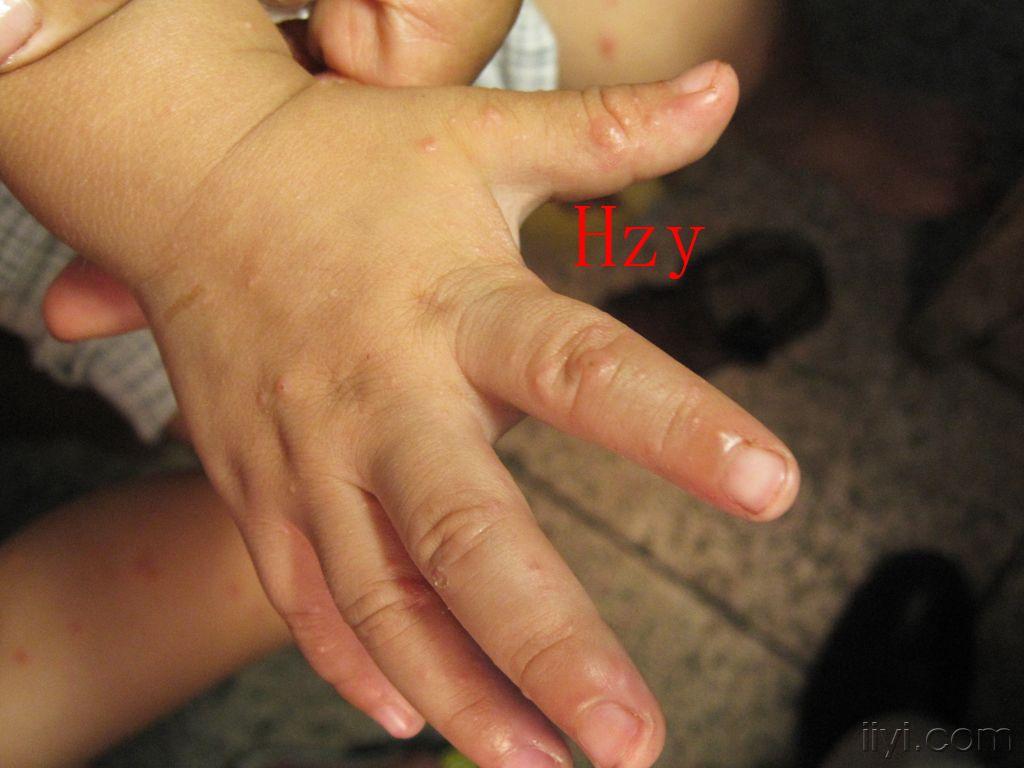 小儿四肢有多数散在皮损公布答案丘疹性肢端皮炎