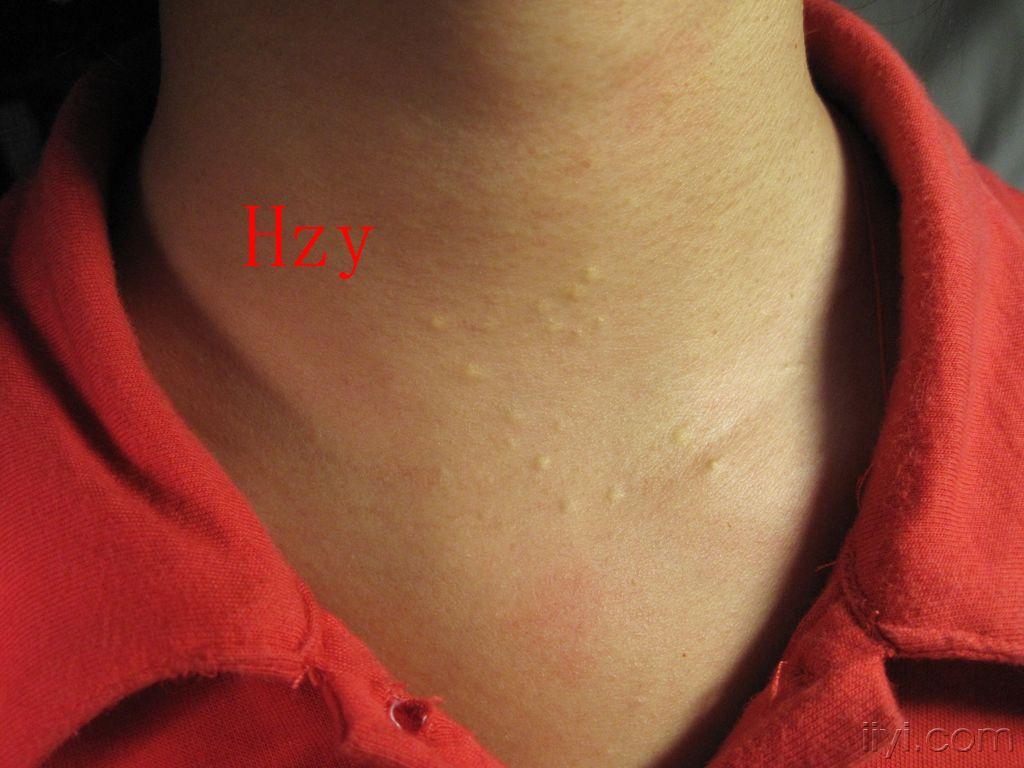 颈部粉瘤图片图片