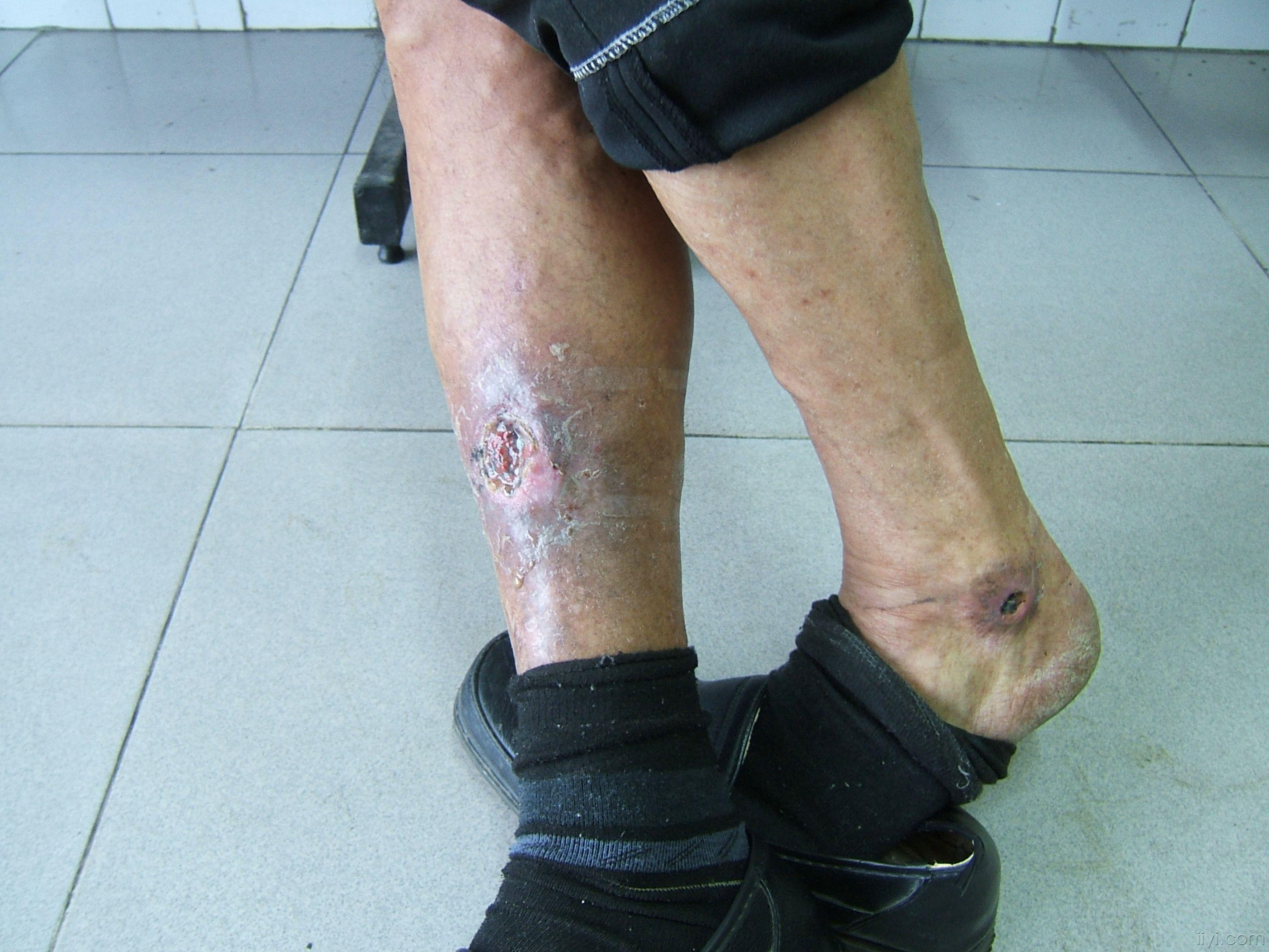 下肢溃疡请教中医高手