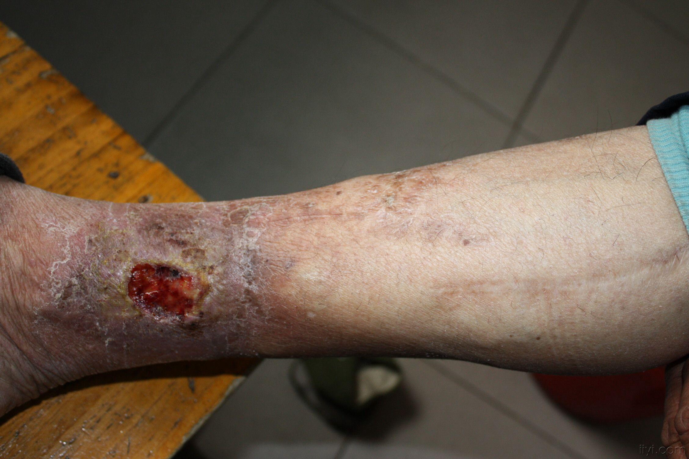 下肢溃疡请教中医高手