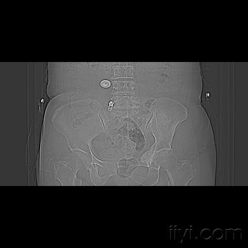 看看这个左侧髂窝软组织肿物