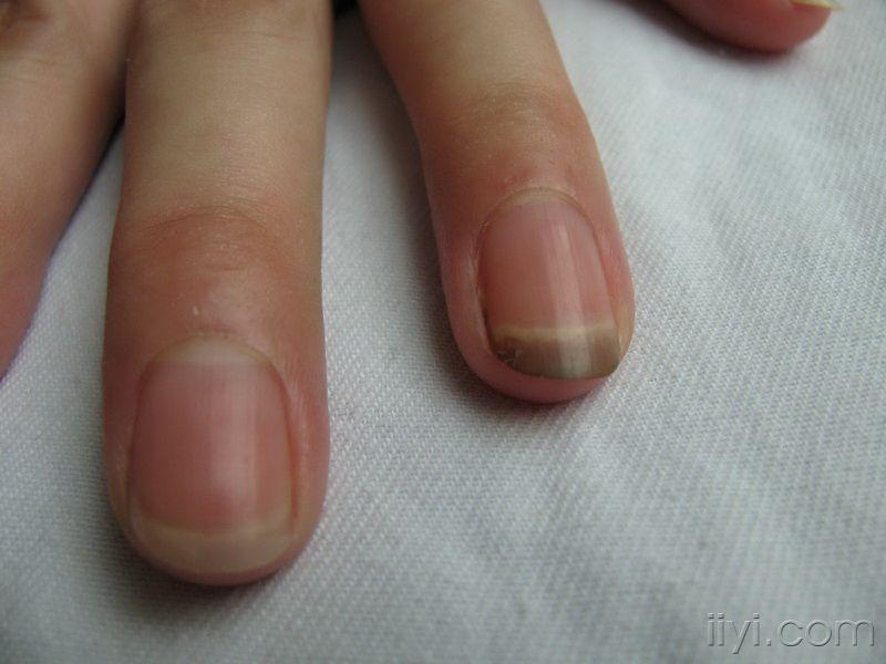 单一指甲颜色改变