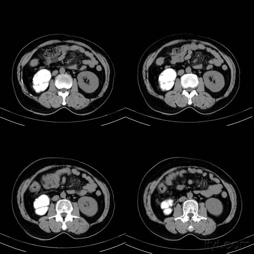 分享一例右侧自截肾