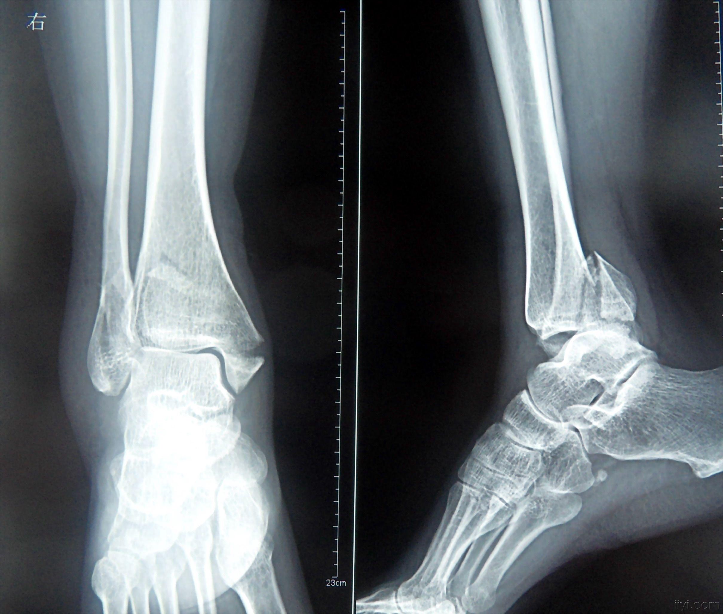 脚踝扭伤的x光图片图片