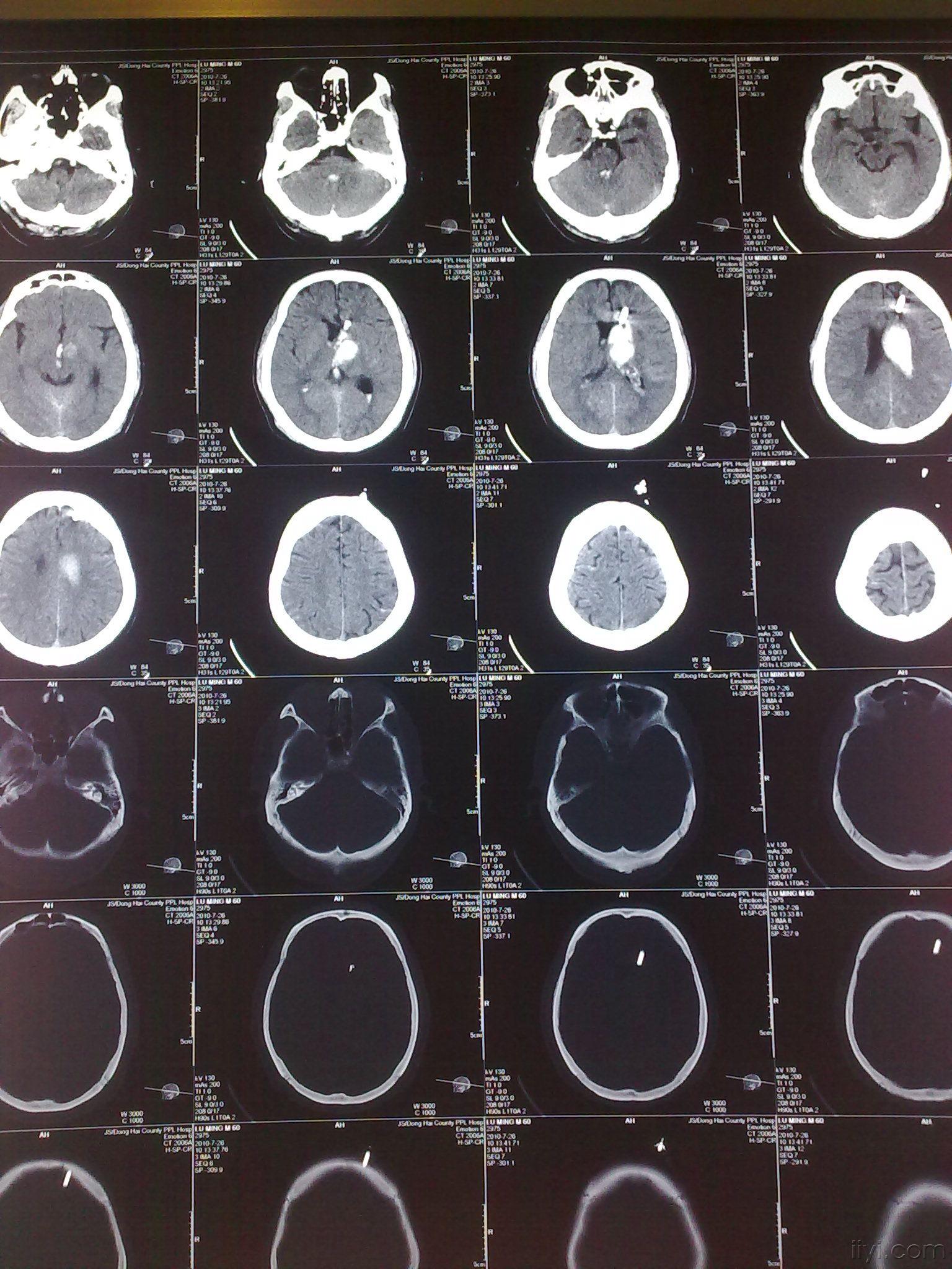 腦出血破入一側腦室一側腦室鑄型