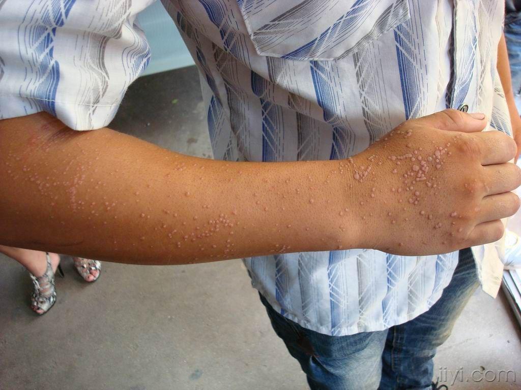 今天接疹的一例疣状表皮发育不良,也可称泛发性扁平疣