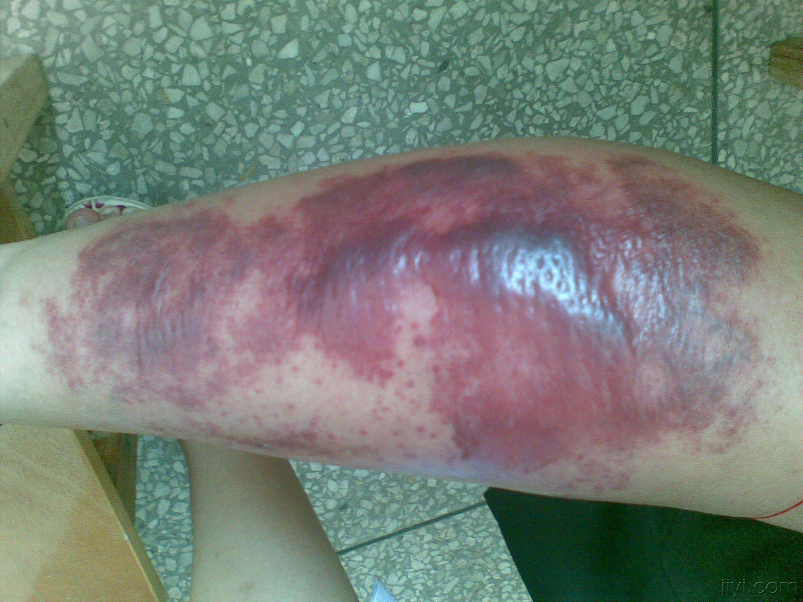 今天见的一病号