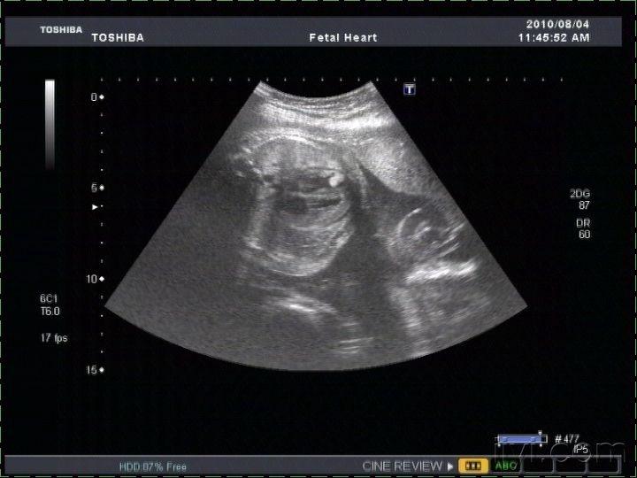 28周做胎儿超声心动图图片