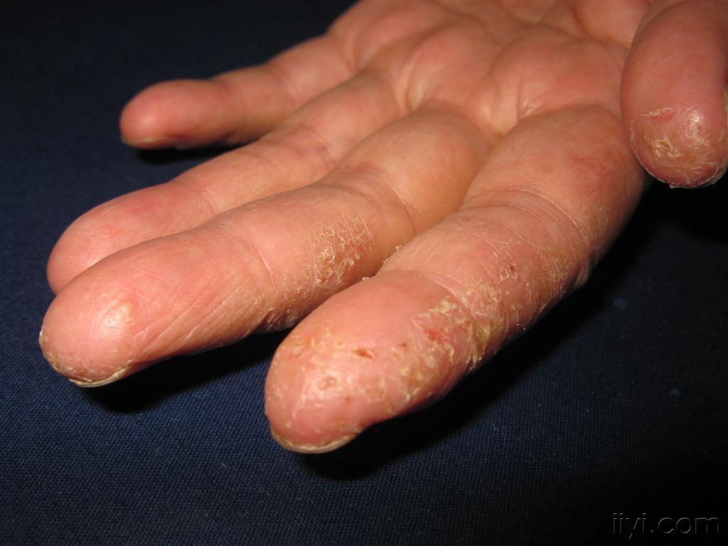 看图识病慢性湿疹