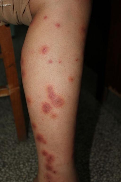 请教大家 看图 皮肤及性传播疾病讨论版 爱爱医医学论坛