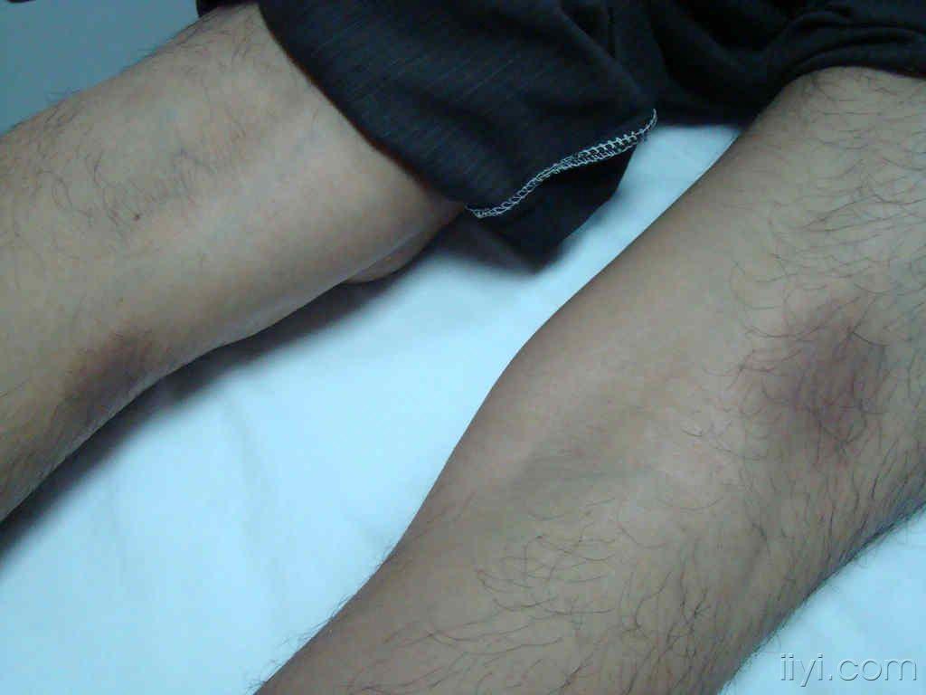 四肢多发性红斑固定性药疹