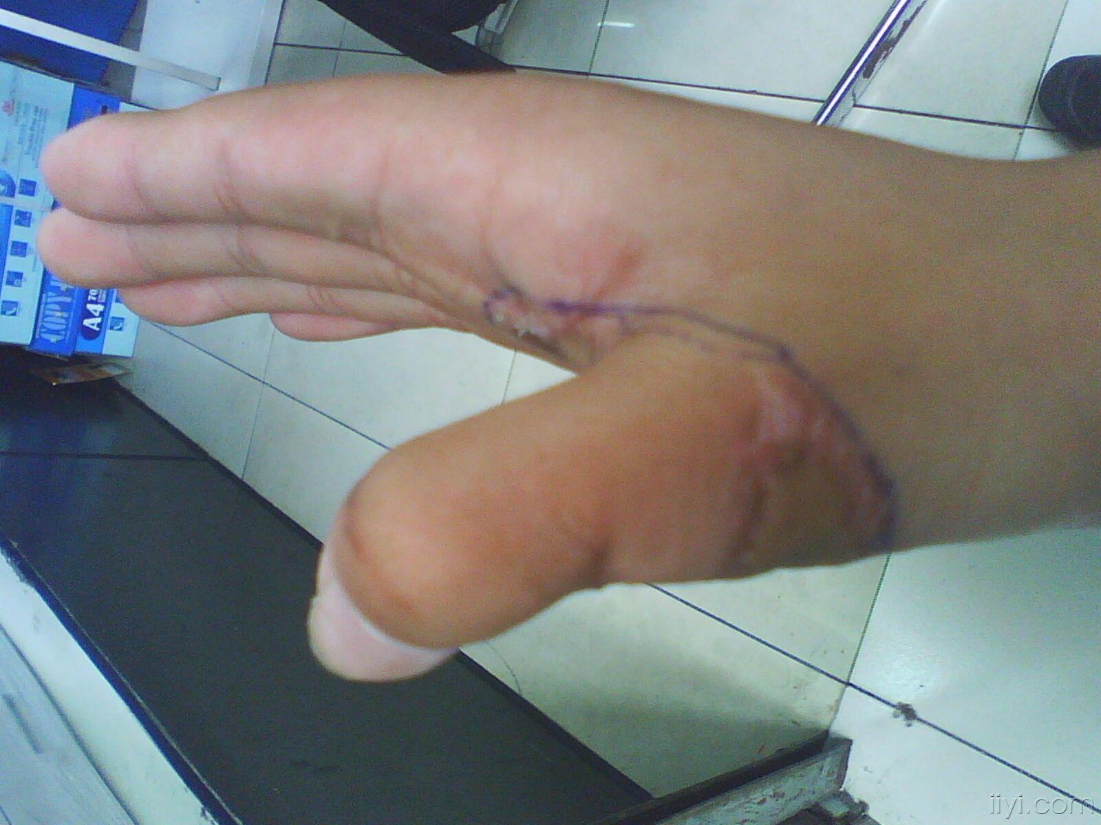 右手大拇指于15年前烧伤后皮肉挛缩畸形现在拇指动不了