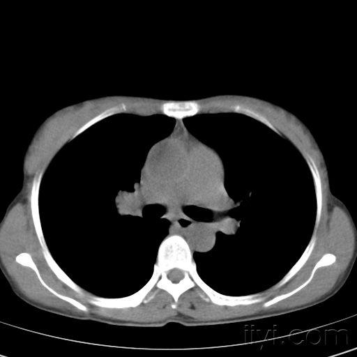 膈肌CT图片