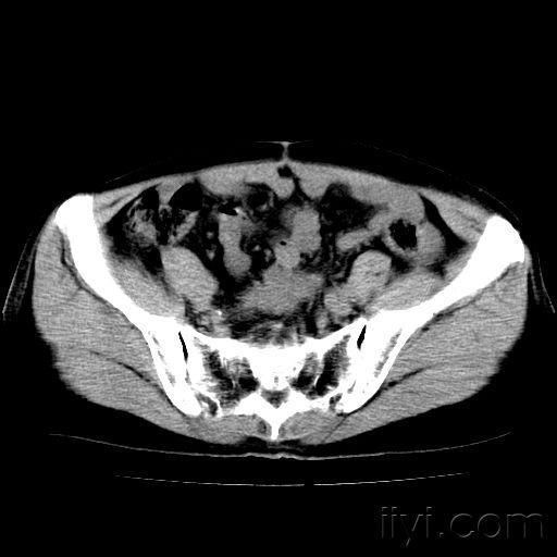 女52岁宫颈癌术后6个月