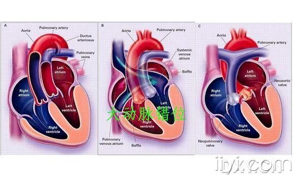 大动脉异位图片