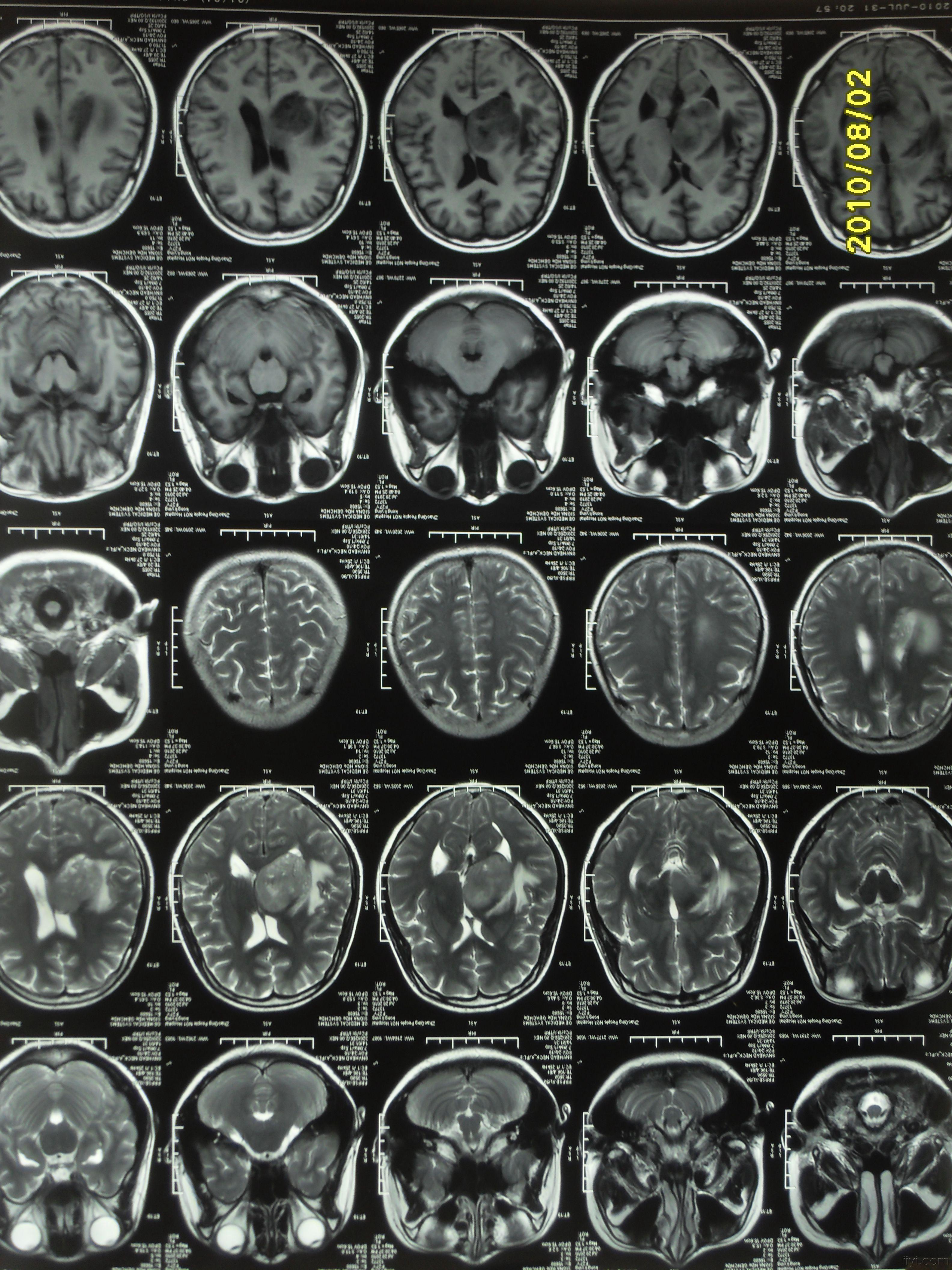 女27岁持续头痛一月余伴头晕呕吐数天脑胶质瘤