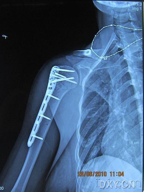 肱骨外科颈粉碎性骨折图片
