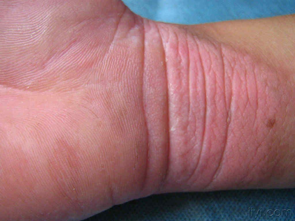 双手掌手指背腕部皮损进行性对称性红斑角皮症