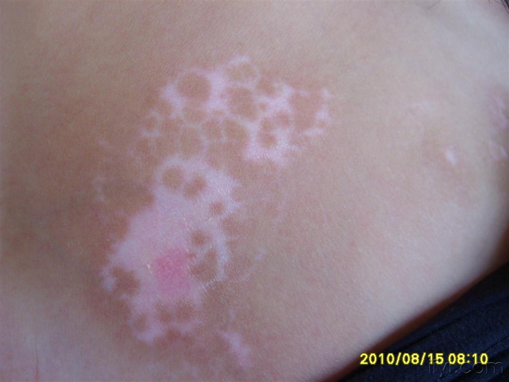 皮肤及性传播疾病讨论版 - 爱爱医医学论坛