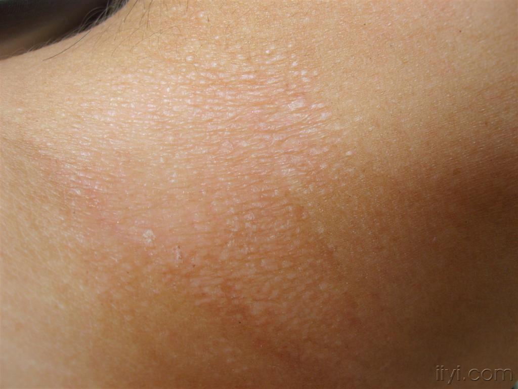 颈部神经性皮炎