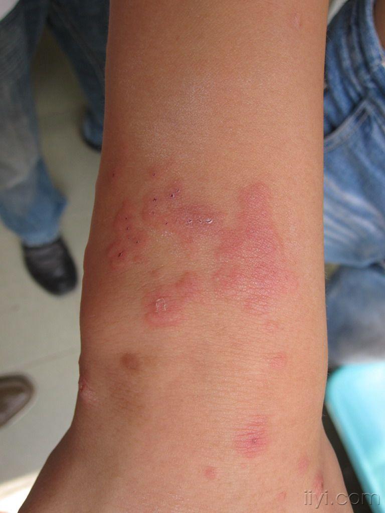 看图识病1公布答案单纯疱疹导致的复发性多形红斑