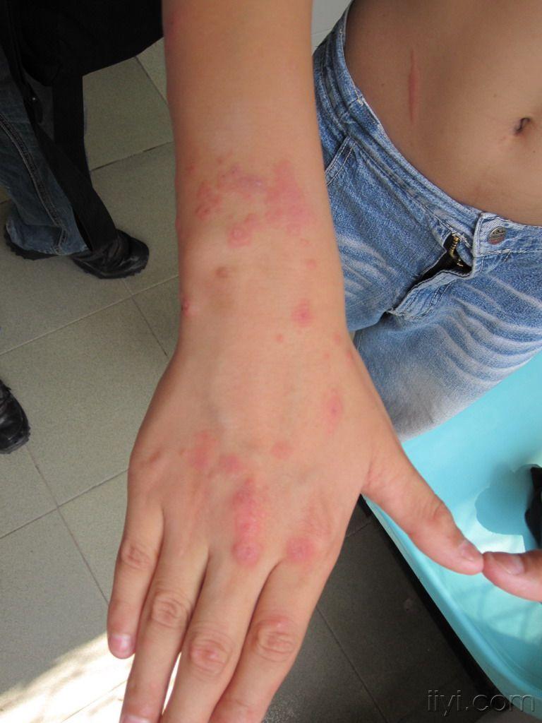 看图识病1公布答案单纯疱疹导致的复发性多形红斑